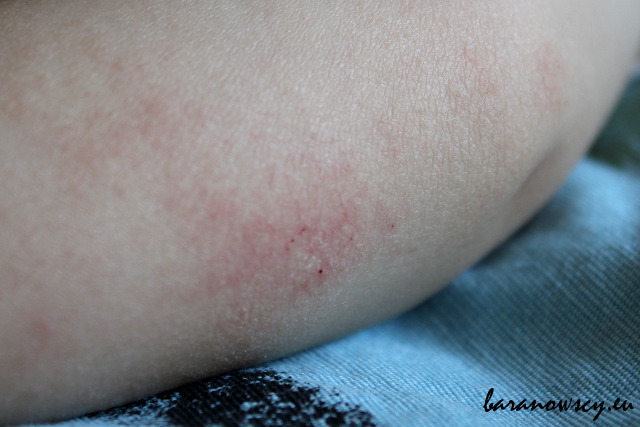 Przesuszona i uszkodzona skóra na rękach - świąd powoduje, że dziecko się drapie i pogarsza stan skóry.